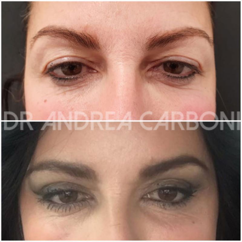 Pre-Post Chirurgia Estetica: Blefaroplastica