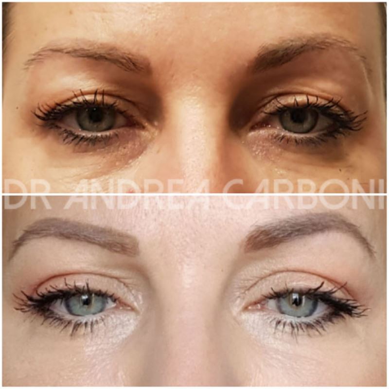 Pre-Post Chirurgia Estetica: Blefaroplastica