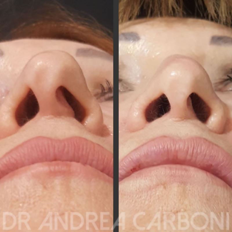 Pre-Post Chirurgia Estetica: plastica nasale