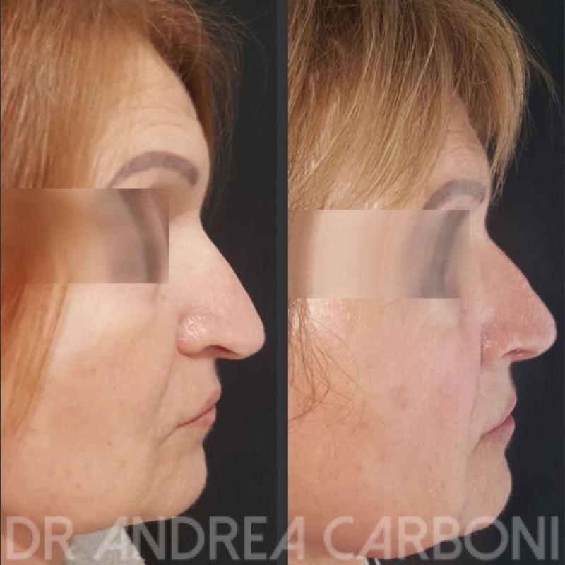 Pre-Post Chirurgia Estetica: plastica punta nasale